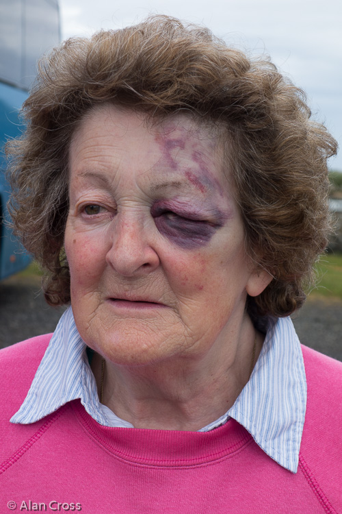 Pat Watson with the black eye that she sustained after a bad fall at Alnwick Gardens. Published here with her express permission - I think she's rather proud of it!